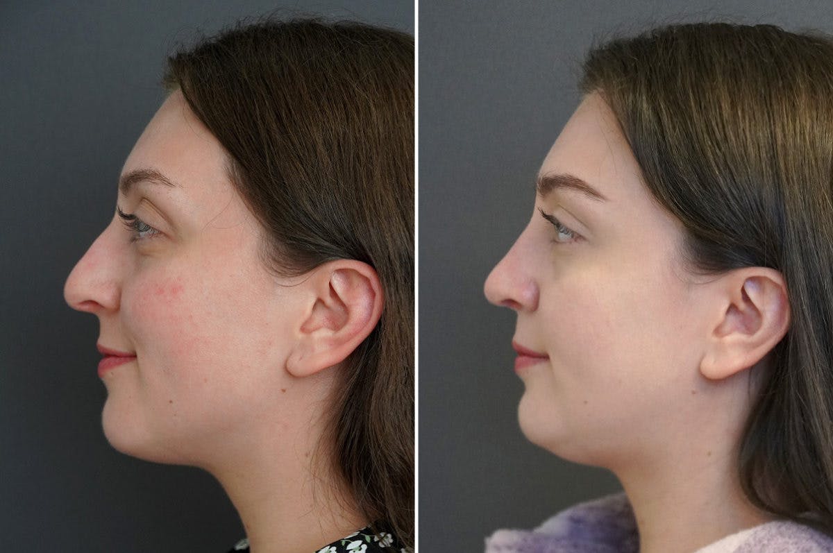 Rhinoplasty Before & After Gallery - Patient 174998162 - Image 3