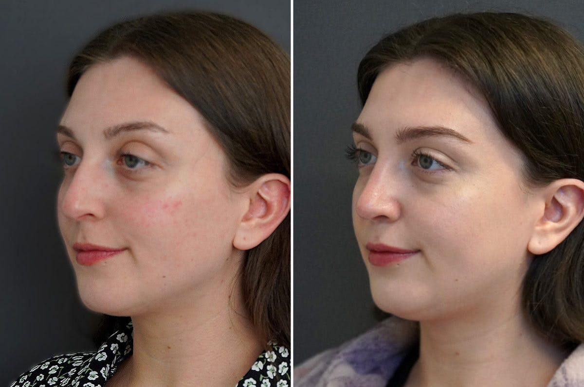Rhinoplasty Before & After Gallery - Patient 174998162 - Image 4