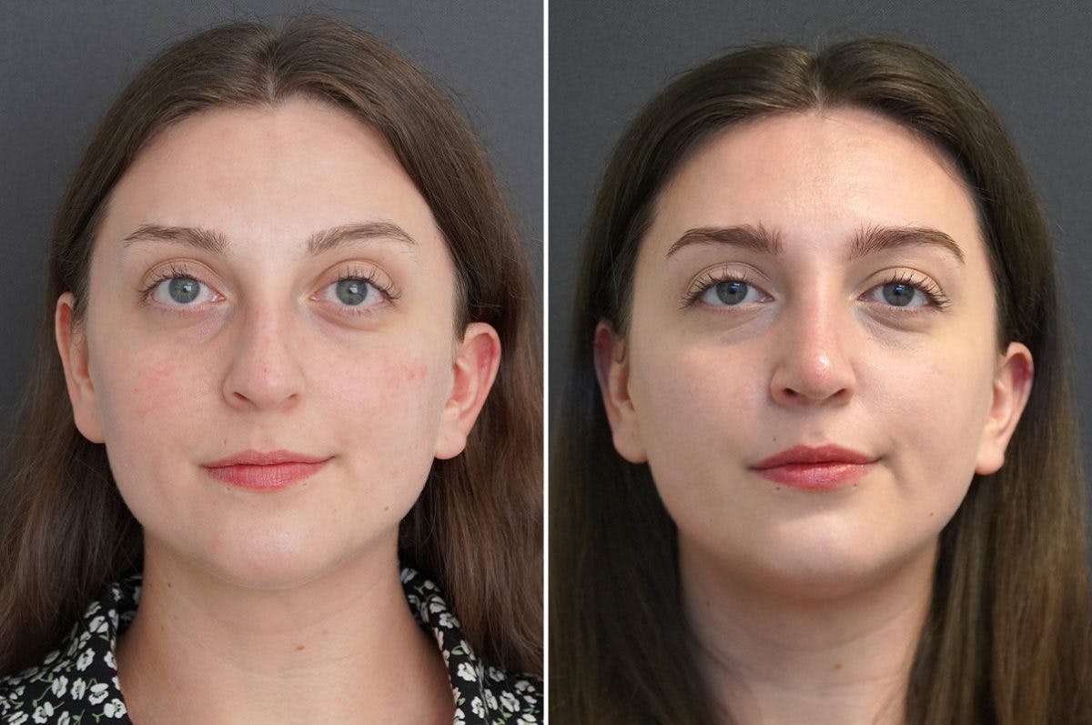 Rhinoplasty Before & After Gallery - Patient 174998162 - Image 5