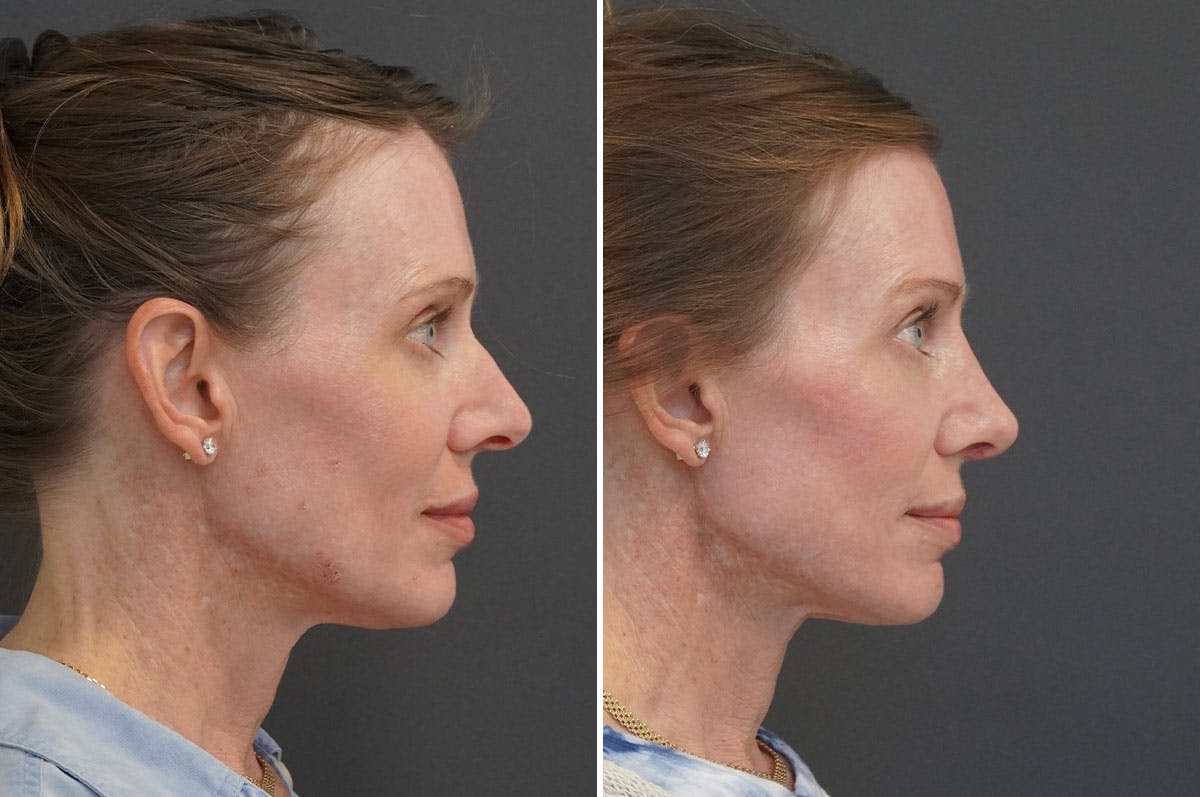 Rhinoplasty Before & After Gallery - Patient 144197 - Image 1
