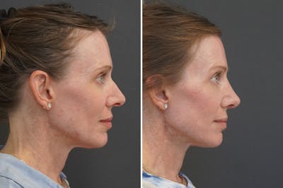 Rhinoplasty Before & After Gallery - Patient 144197 - Image 1