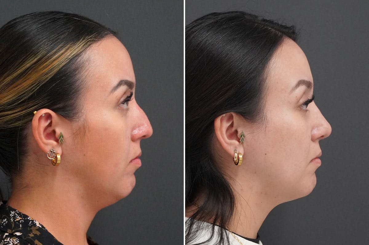 Rhinoplasty Before & After Gallery - Patient 174998144 - Image 1