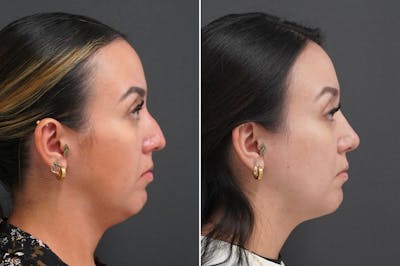 Rhinoplasty Before & After Gallery - Patient 174998144 - Image 1