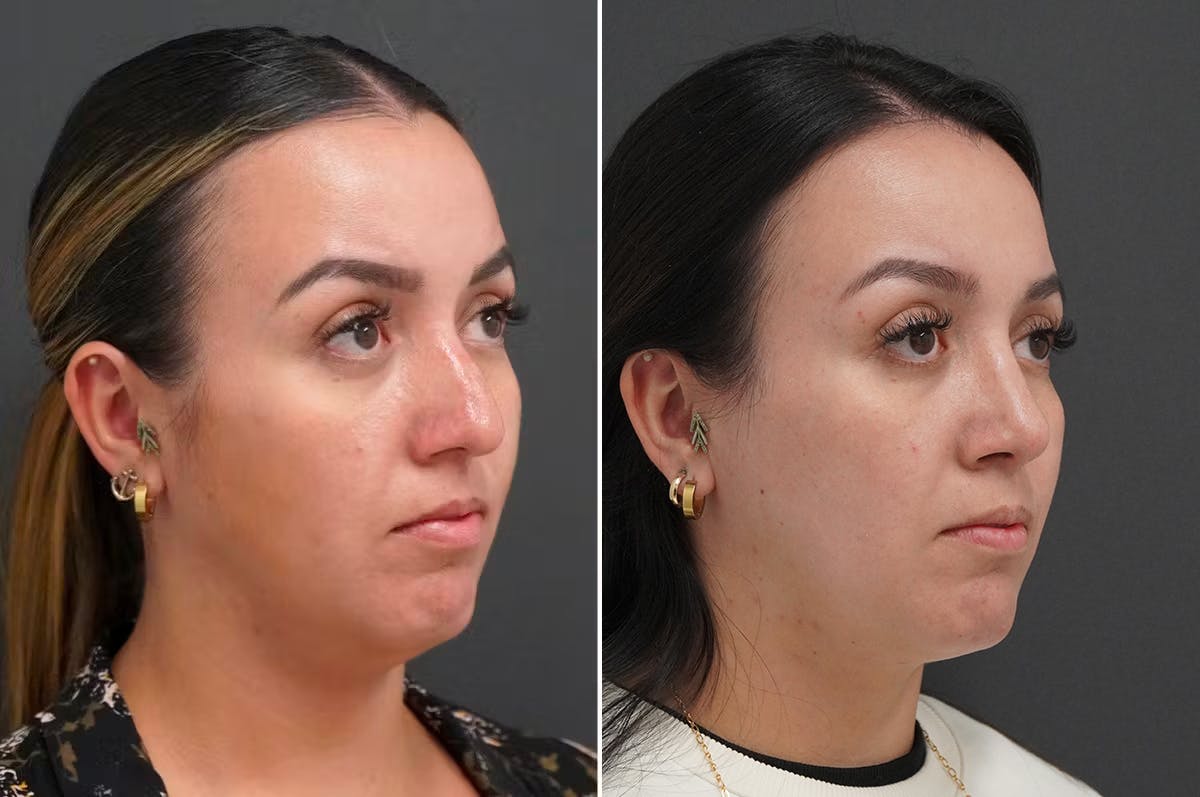 Rhinoplasty Before & After Gallery - Patient 174998144 - Image 2