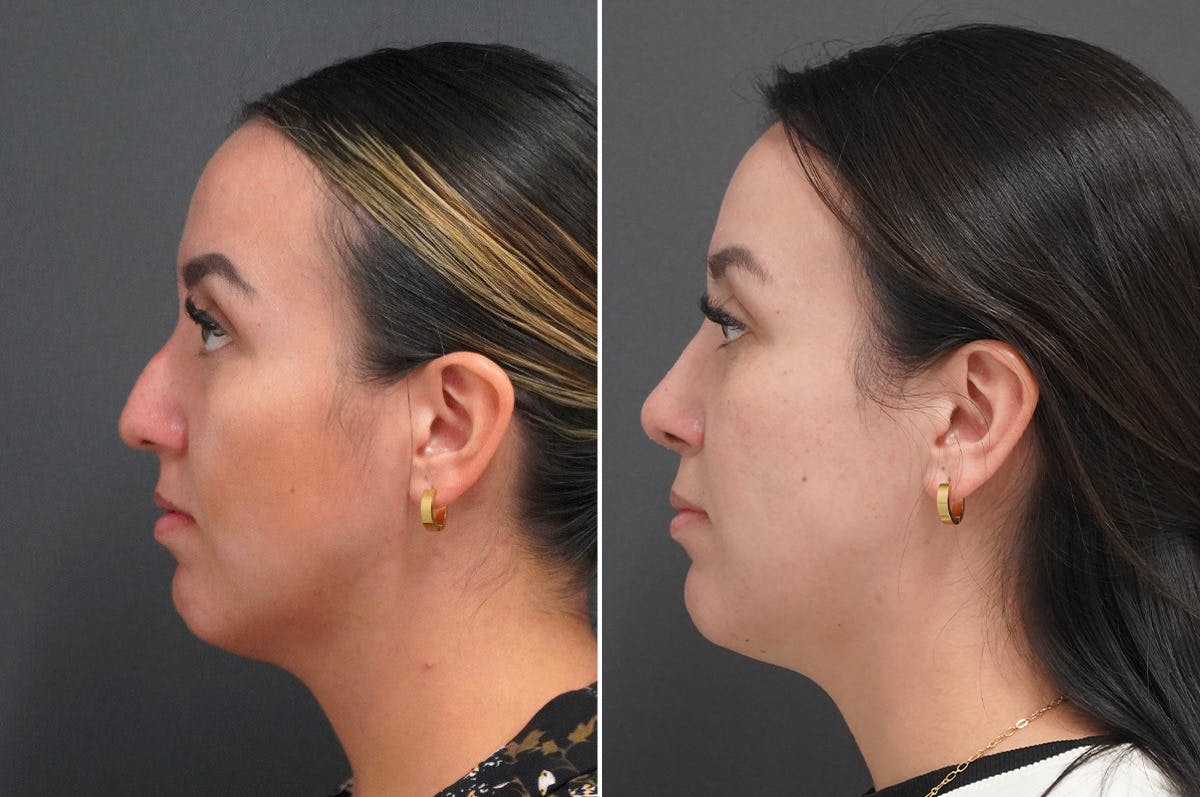 Rhinoplasty Before & After Gallery - Patient 174998144 - Image 3