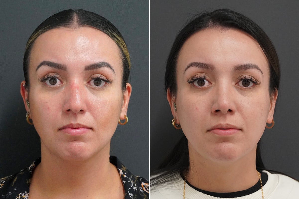 Rhinoplasty Before & After Gallery - Patient 174998144 - Image 4