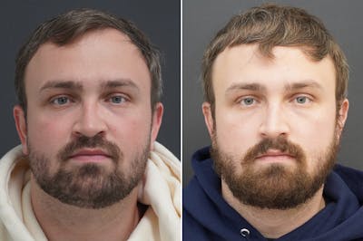Rhinoplasty Before & After Gallery - Patient 104369 - Image 1