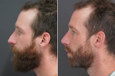 Revision Rhinoplasty Before & After Gallery - Patient 386366 - Image 1