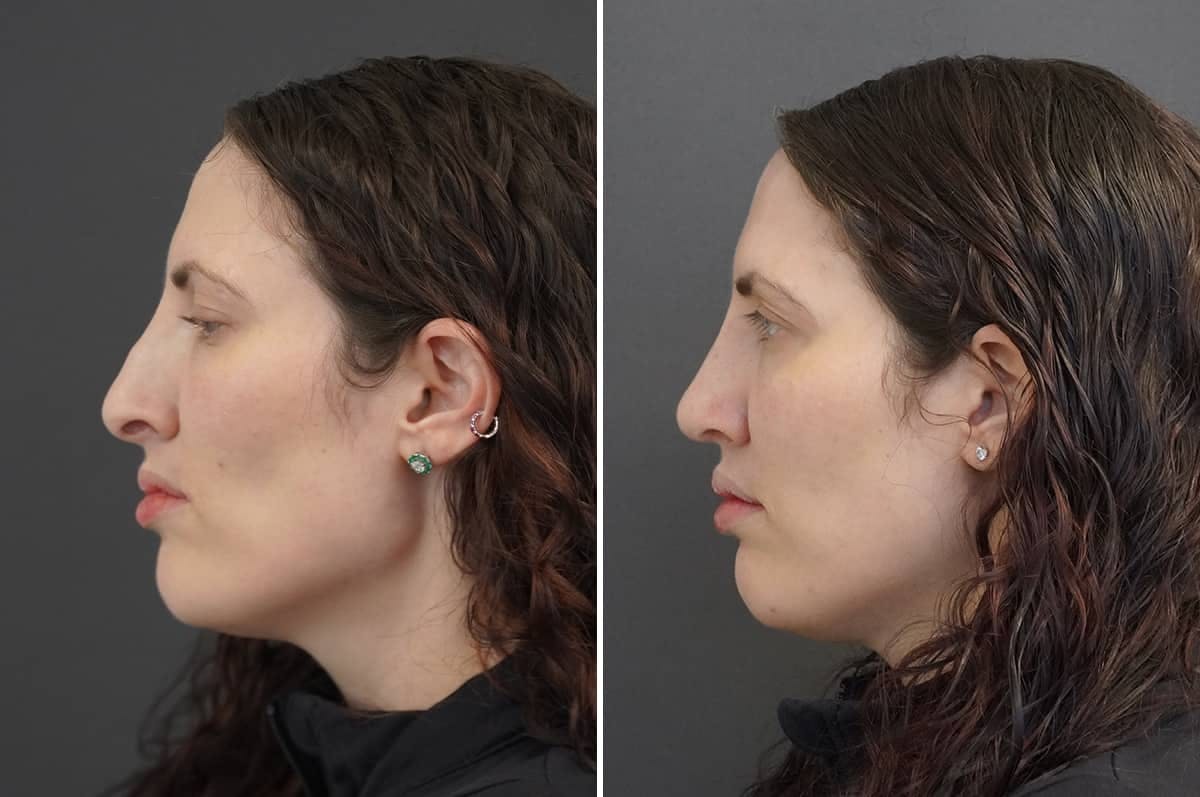 Rhinoplasty Before & After Gallery - Patient 402088 - Image 2