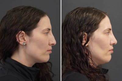 Rhinoplasty Before & After Gallery - Patient 402088 - Image 1