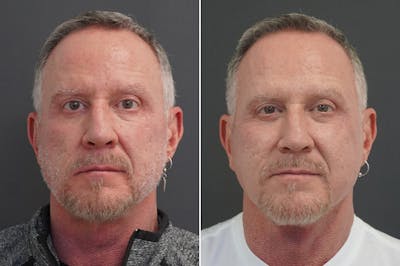 Facelift Before & After Gallery - Patient 185256 - Image 1