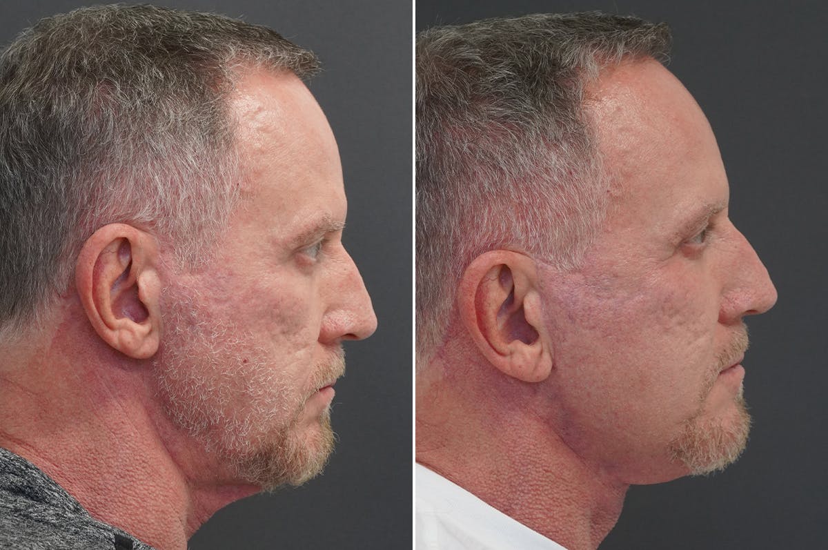 Facelift Before & After Gallery - Patient 185256 - Image 3