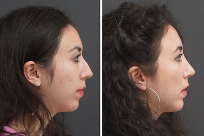 Rhinoplasty Before & After Gallery - Patient 348569 - Image 1