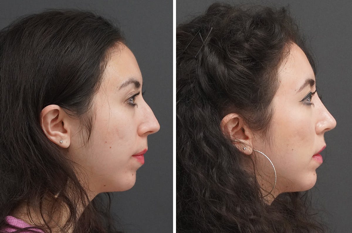 Rhinoplasty Before & After Gallery - Patient 348569 - Image 1