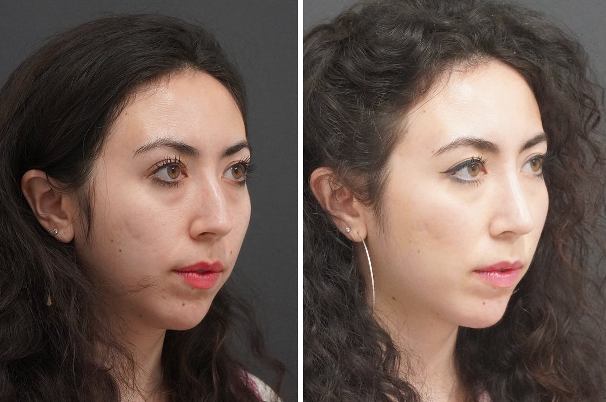 Rhinoplasty Before & After Gallery - Patient 348569 - Image 2