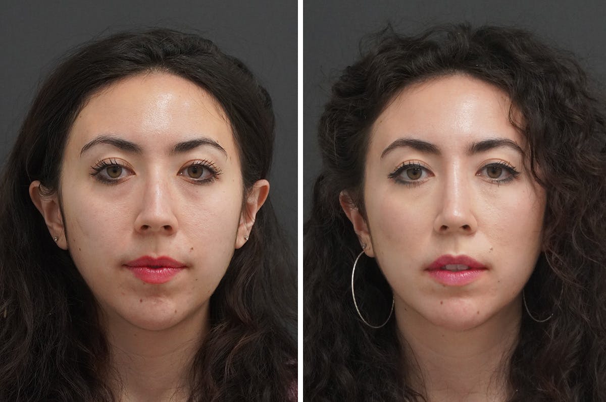 Rhinoplasty Before & After Gallery - Patient 348569 - Image 3