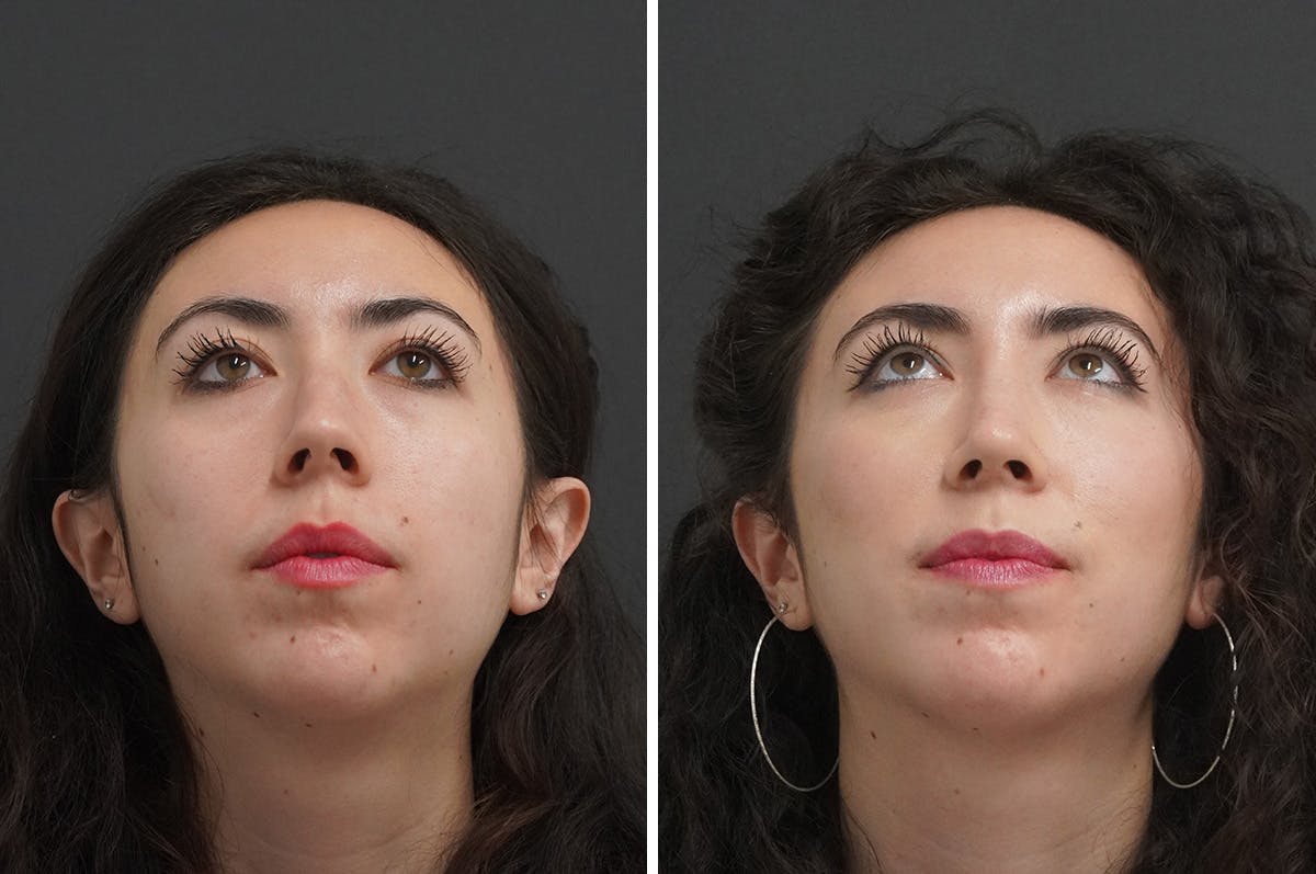 Rhinoplasty Before & After Gallery - Patient 348569 - Image 4
