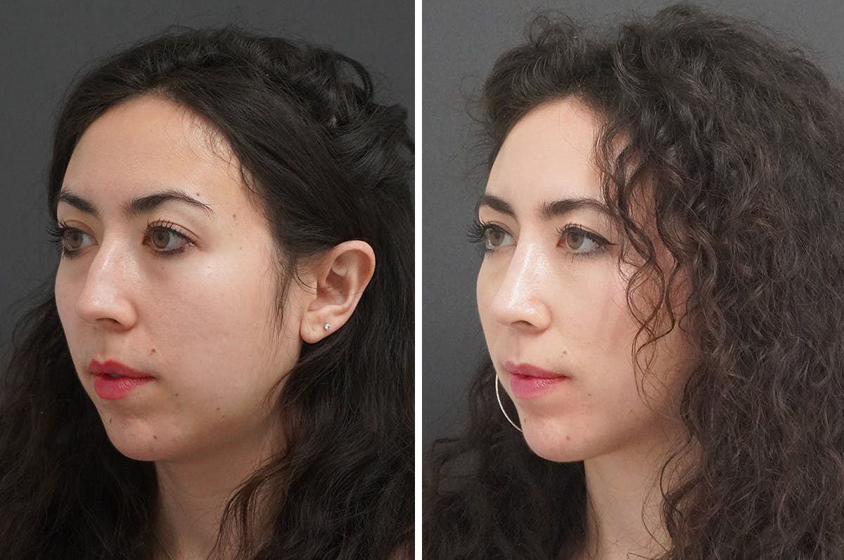 Rhinoplasty Before & After Gallery - Patient 348569 - Image 5