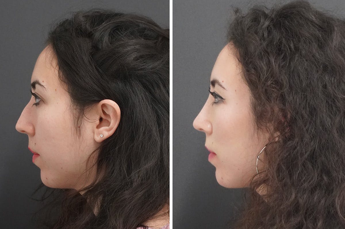 Rhinoplasty Before & After Gallery - Patient 348569 - Image 6