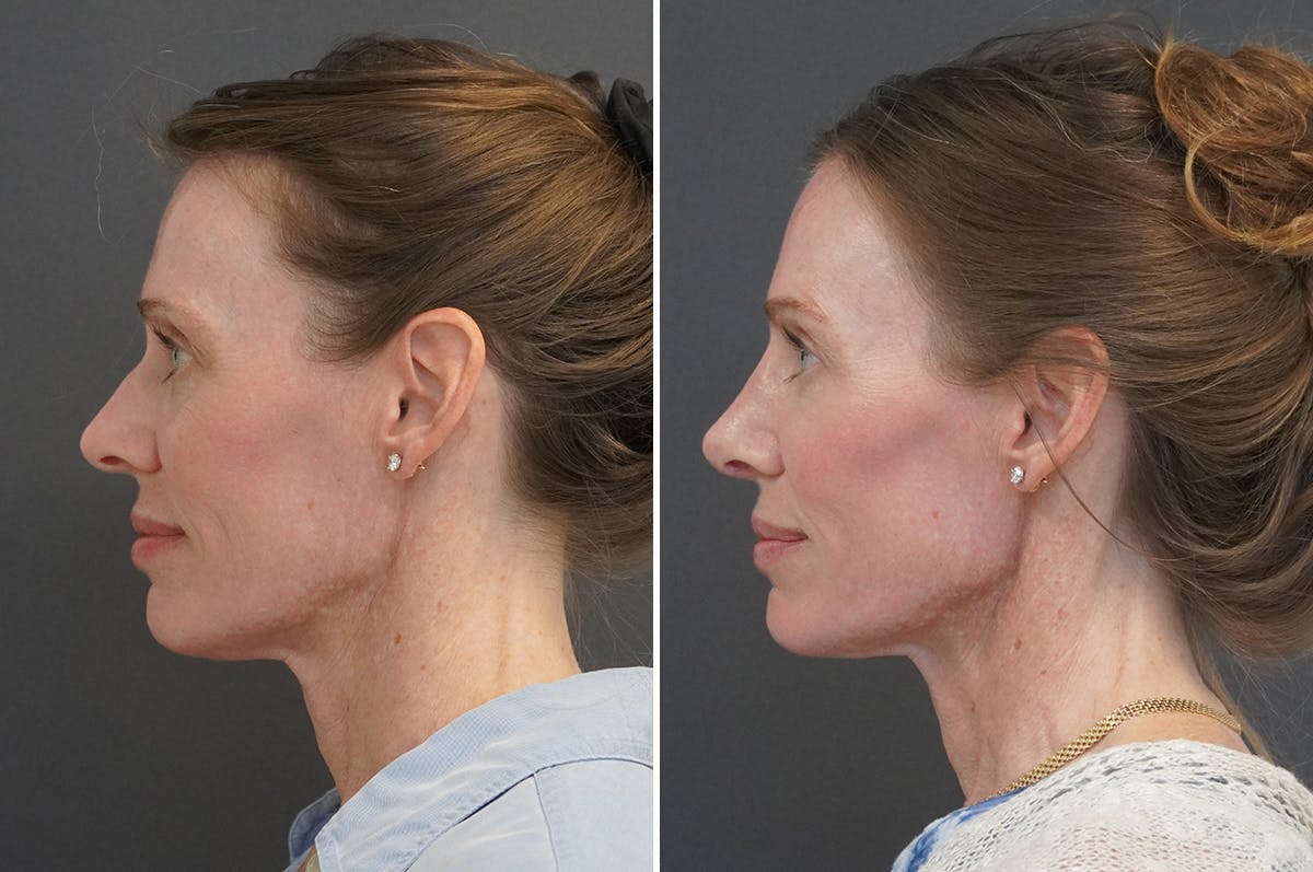 Rhinoplasty Before & After Gallery - Patient 144197 - Image 4