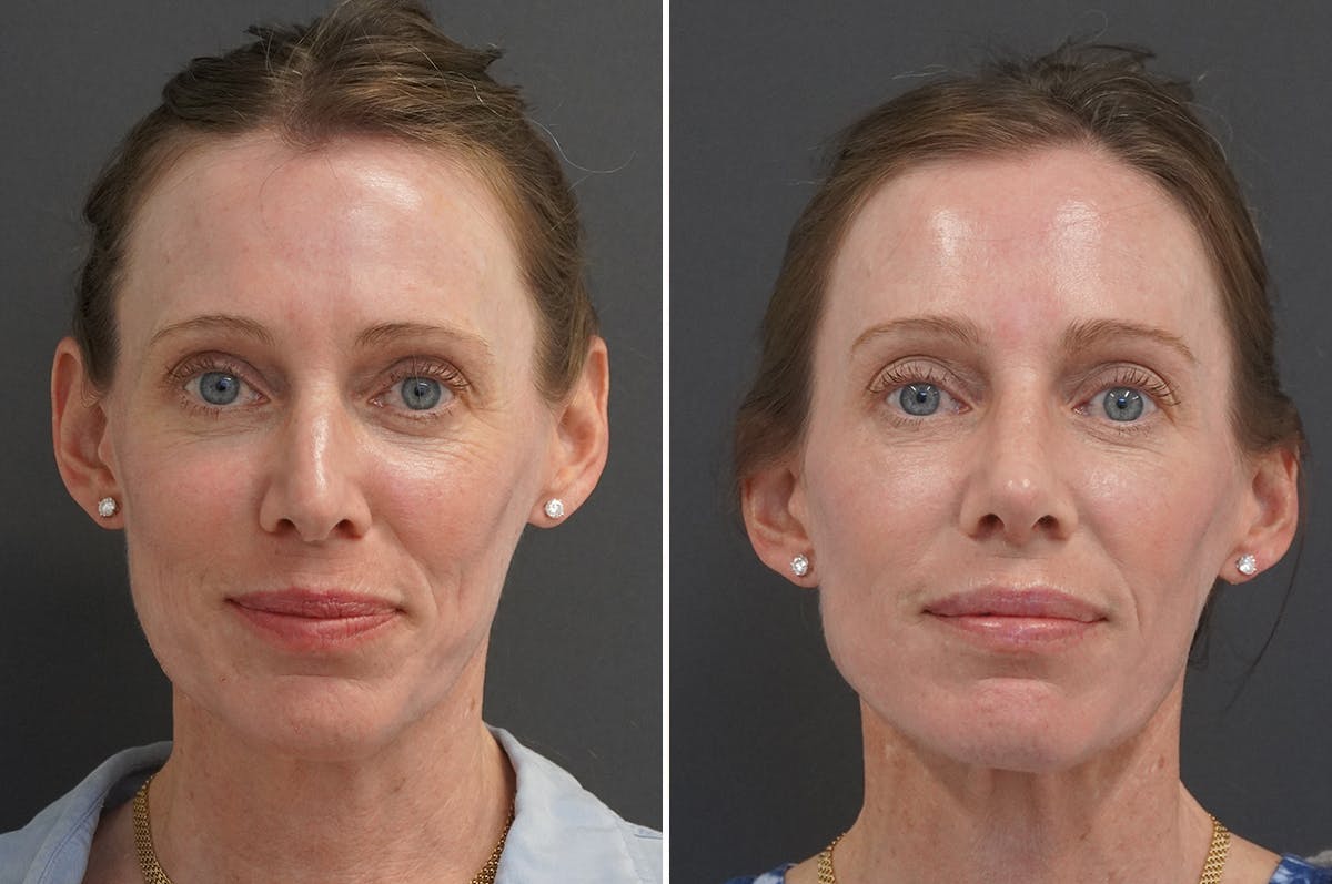Rhinoplasty Before & After Gallery - Patient 144197 - Image 3