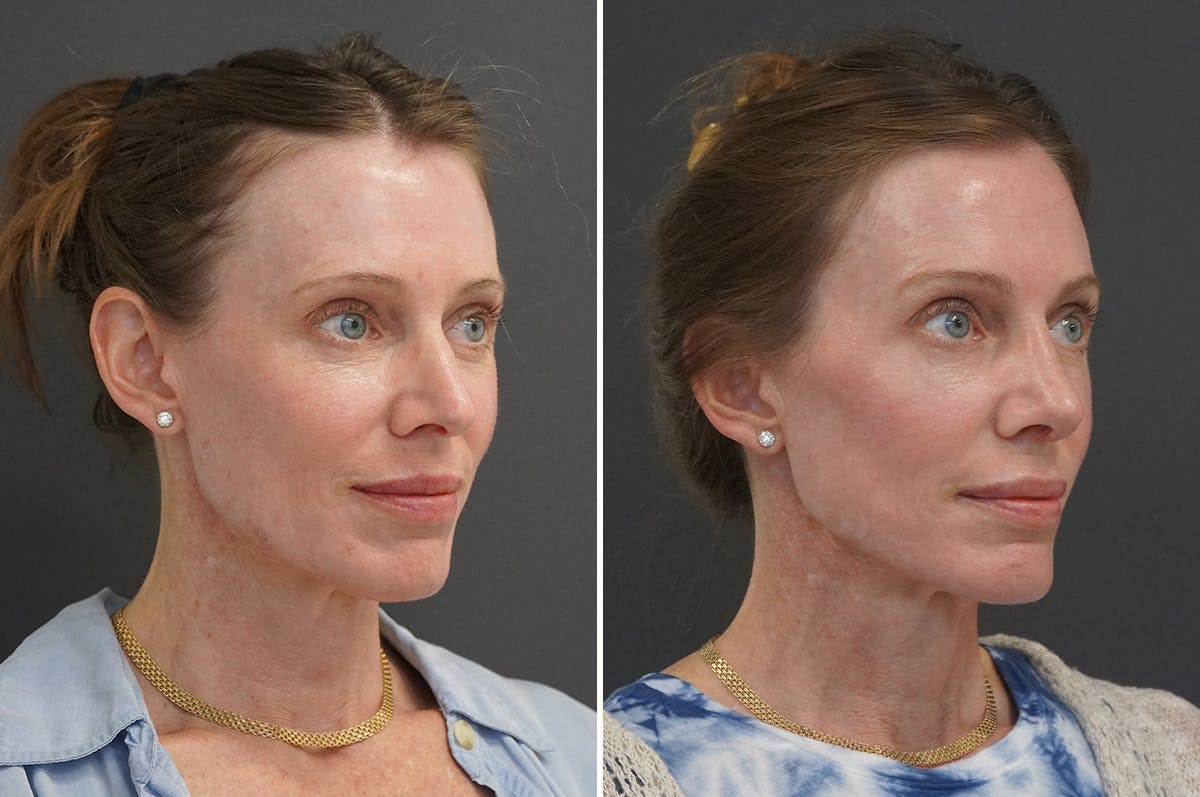 Rhinoplasty Before & After Gallery - Patient 144197 - Image 2
