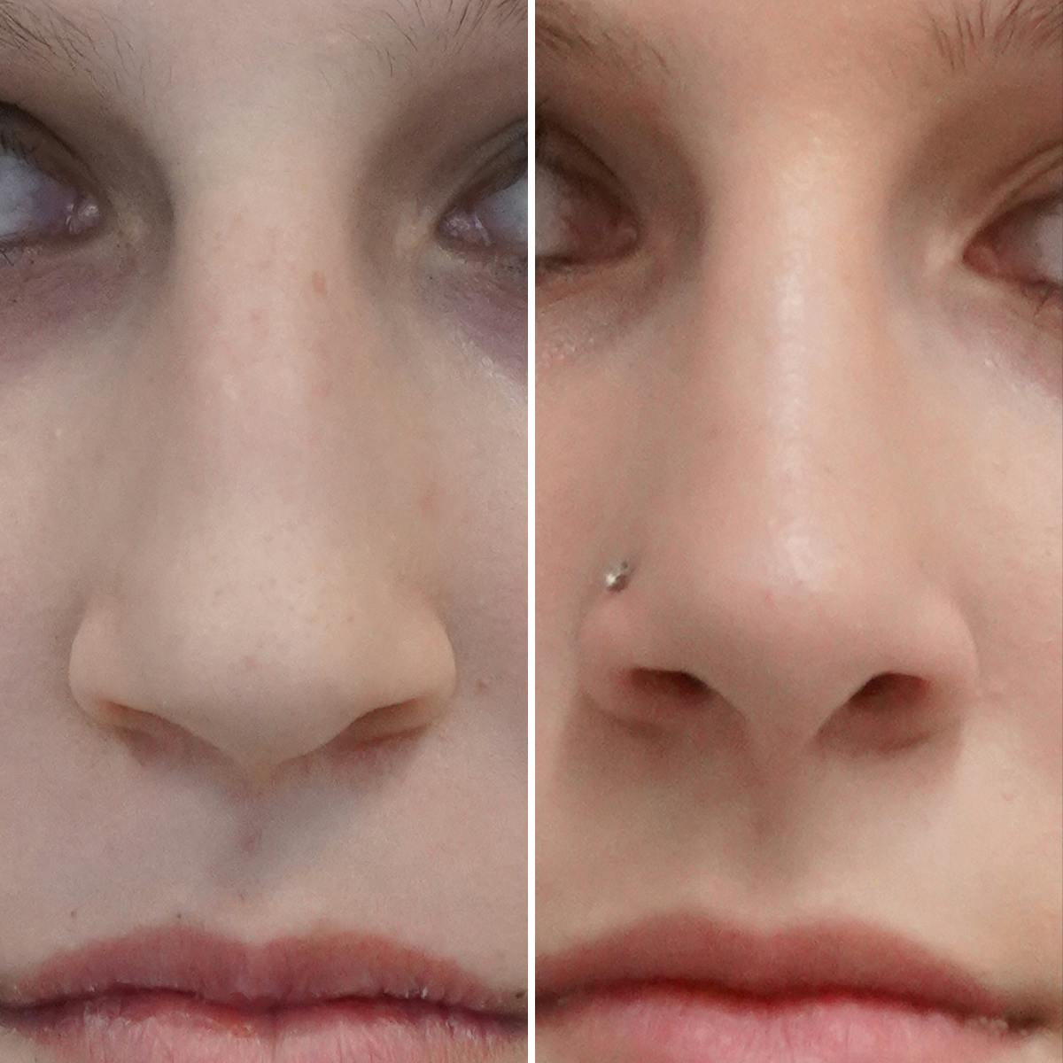 Rhinoplasty Before & After Gallery - Patient 144869 - Image 3