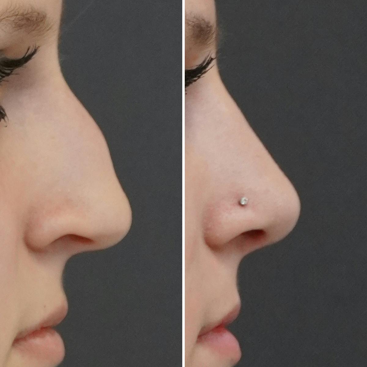 Rhinoplasty Before & After Gallery - Patient 144869 - Image 1