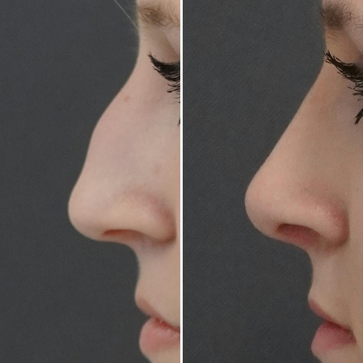 Rhinoplasty Before & After Gallery - Patient 144869 - Image 2