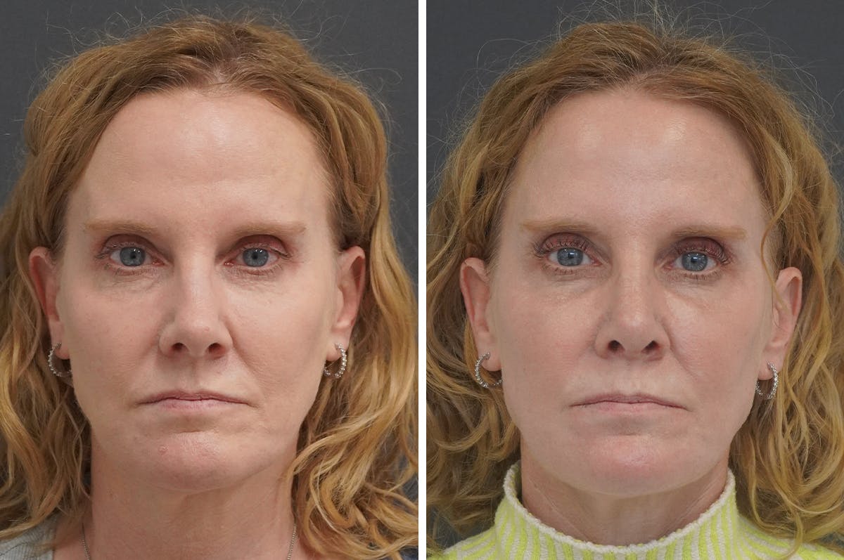 Rhinoplasty Before & After Gallery - Patient 401313 - Image 1