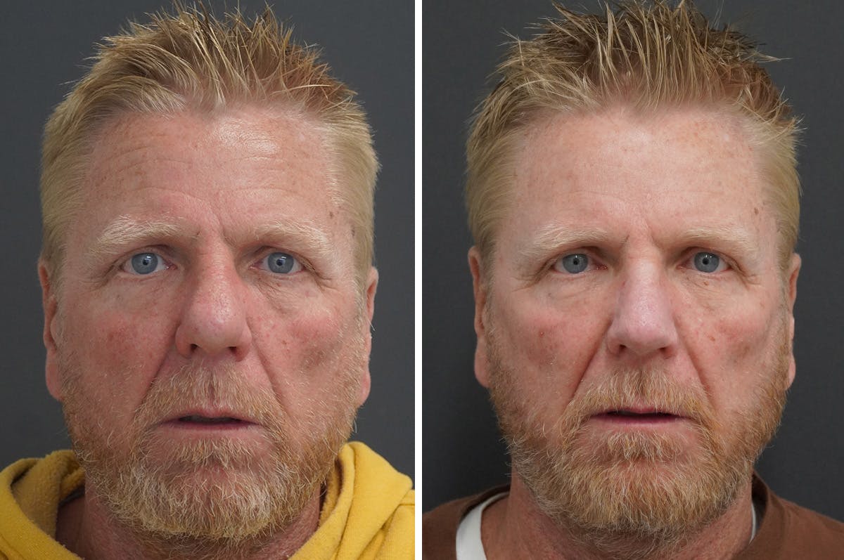 Rhinophyma Before & After Gallery - Patient 327397 - Image 1