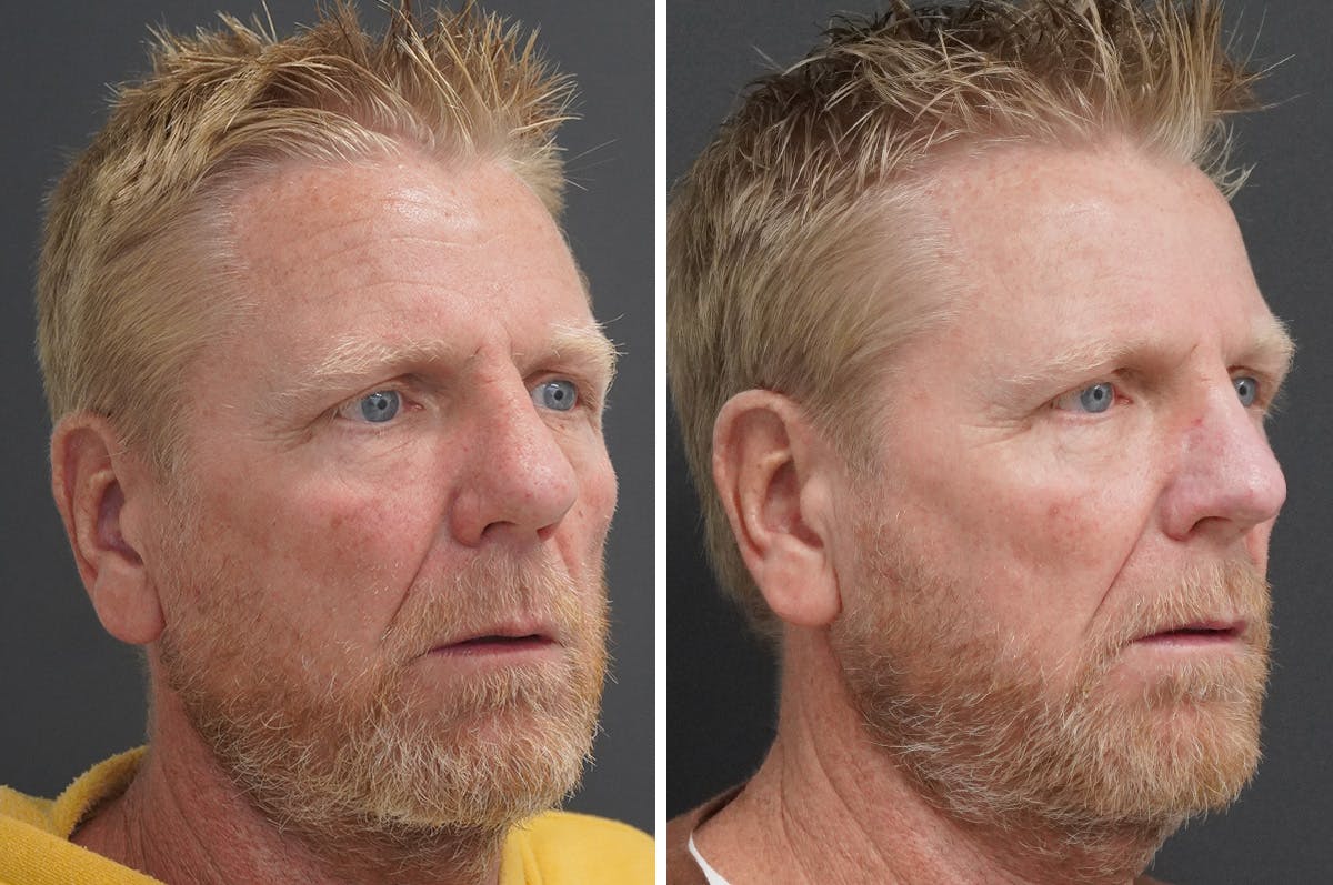 Rhinophyma Before & After Gallery - Patient 327397 - Image 2