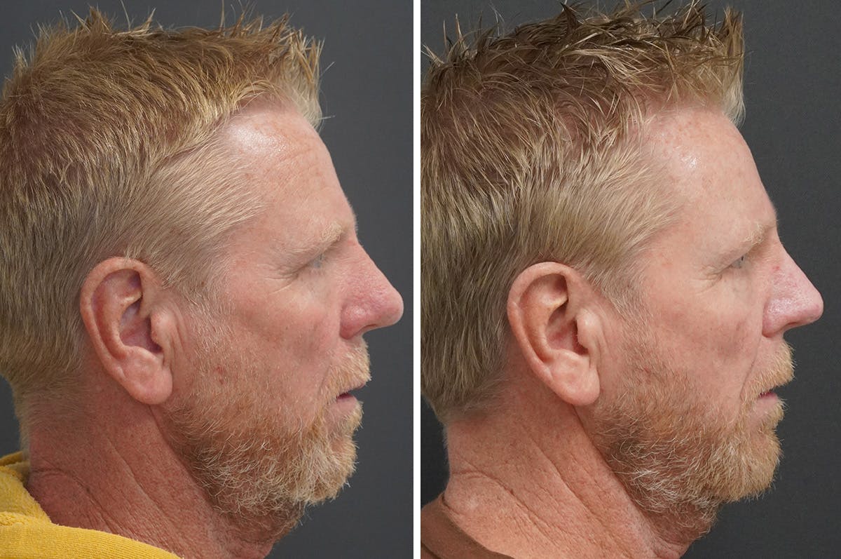 Rhinophyma Before & After Gallery - Patient 327397 - Image 3