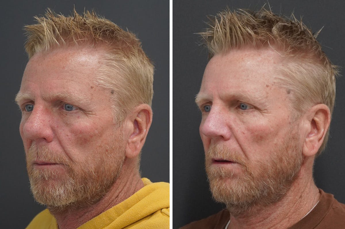 Rhinophyma Before & After Gallery - Patient 327397 - Image 4