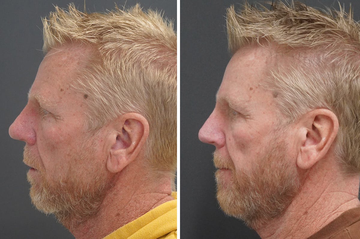 Rhinophyma Before & After Gallery - Patient 327397 - Image 5