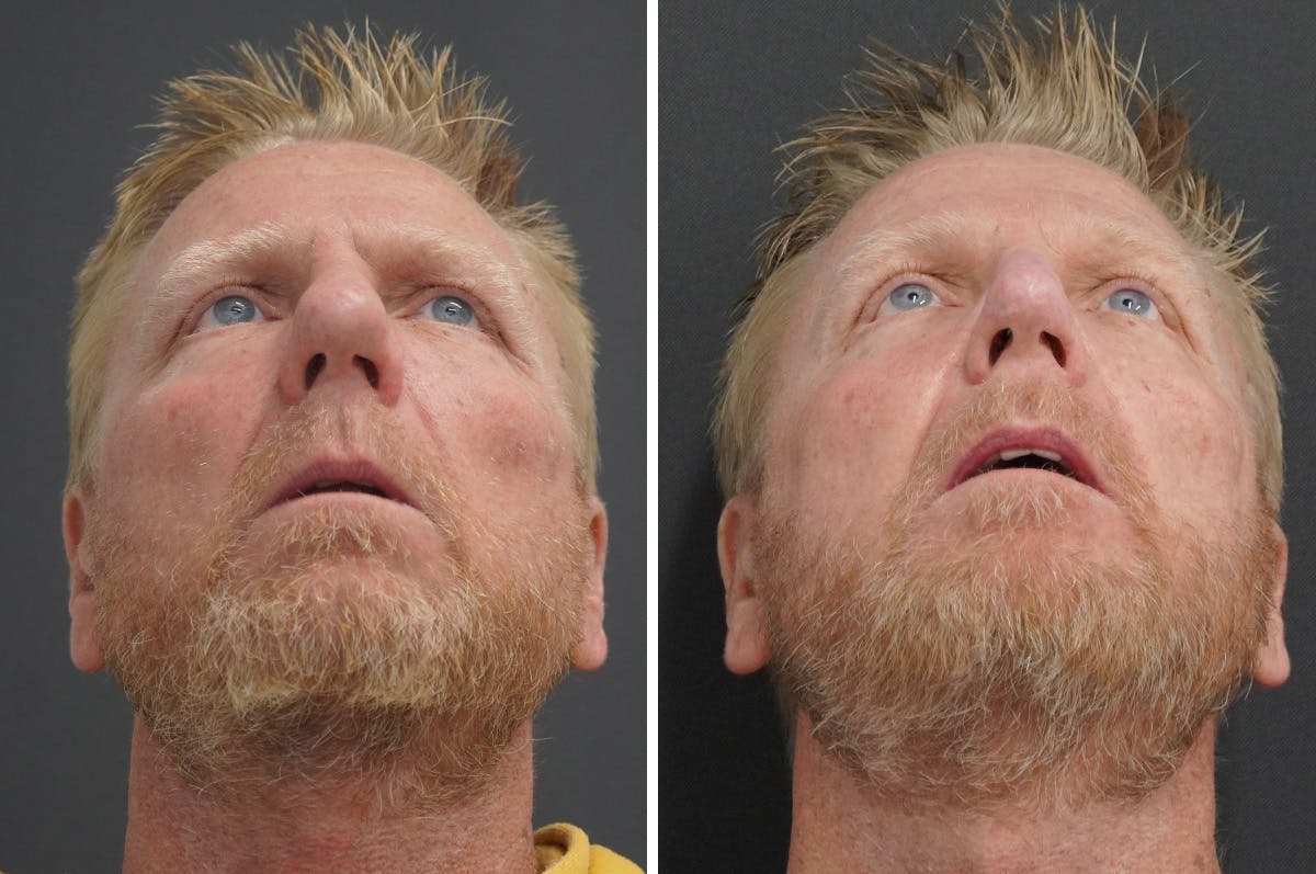 Rhinophyma Before & After Gallery - Patient 327397 - Image 6