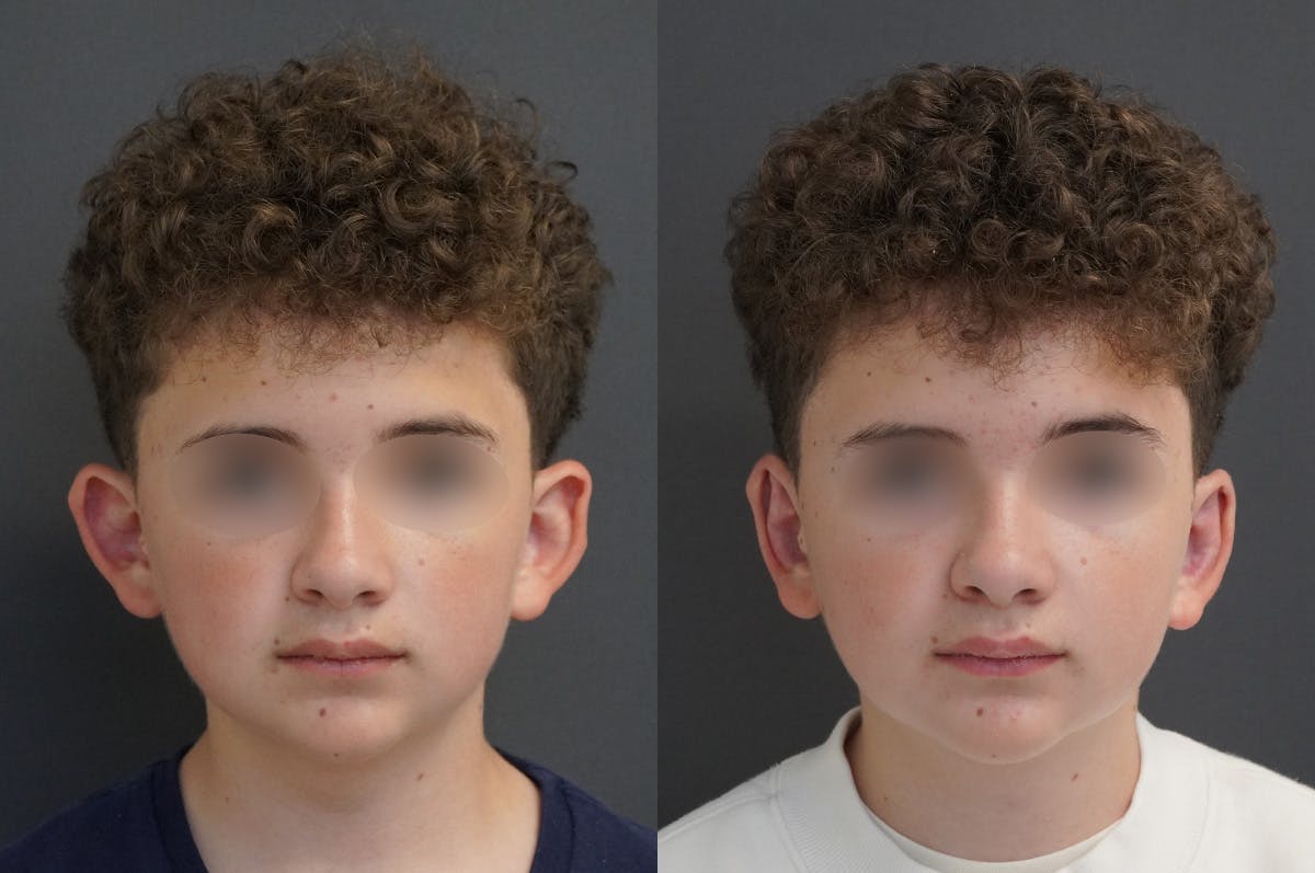 Otoplasty Before & After Gallery - Patient 224634 - Image 1