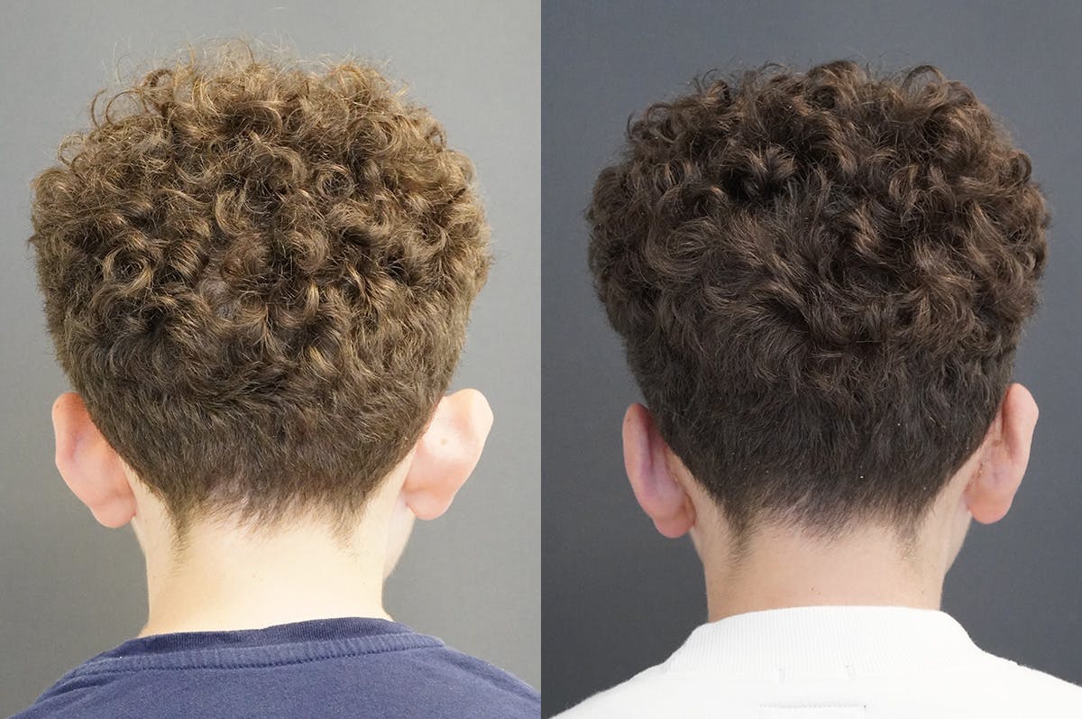 Otoplasty Before & After Gallery - Patient 224634 - Image 2