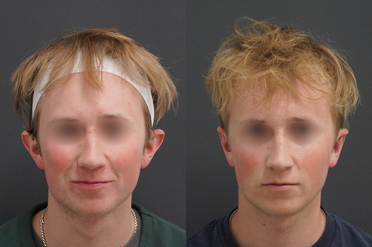 Otoplasty Before & After Gallery - Patient 340631 - Image 1