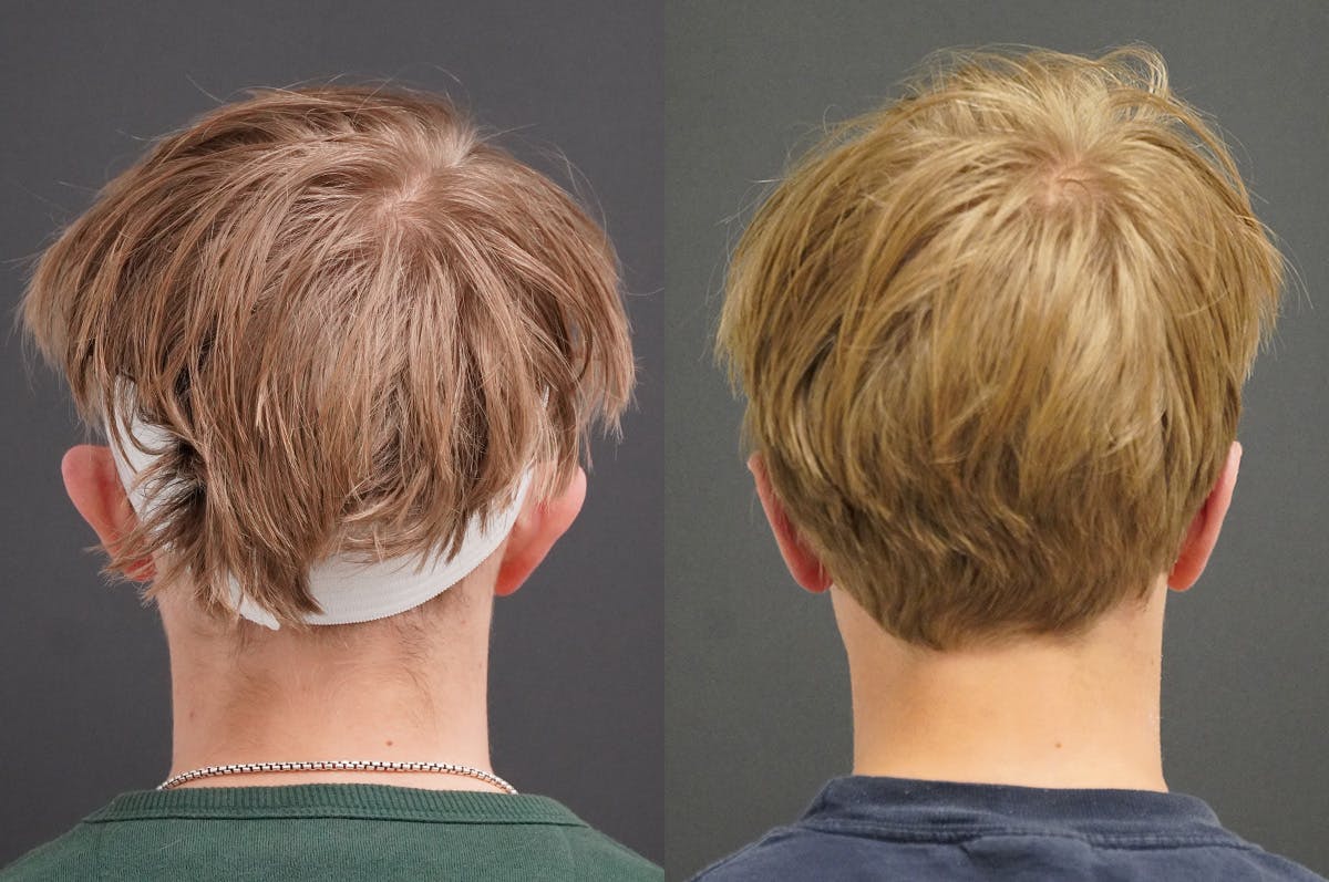 Otoplasty Before & After Gallery - Patient 340631 - Image 2