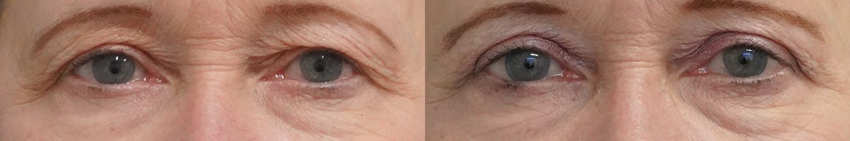 Blepharoplasty Before & After Gallery - Patient 436627 - Image 1