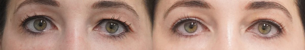 Blepharoplasty Before & After Gallery - Patient 329333 - Image 1