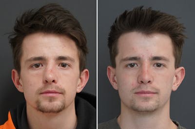 Rhinoplasty Before & After Gallery - Patient 290695 - Image 1