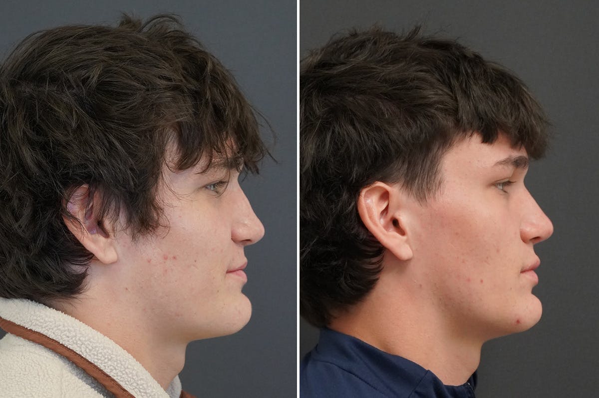 Rhinoplasty Before & After Gallery - Patient 334085 - Image 1