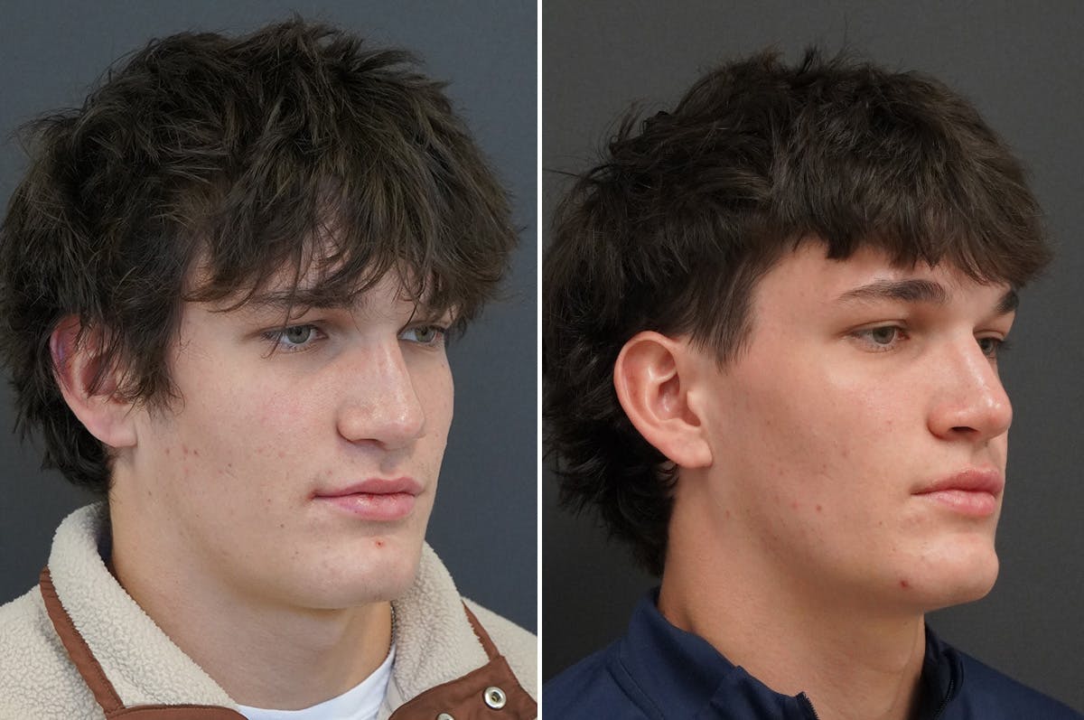 Rhinoplasty Before & After Gallery - Patient 334085 - Image 2
