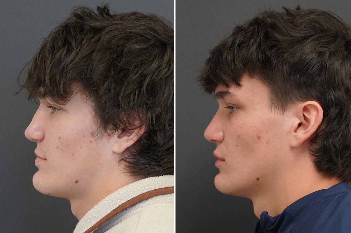 Rhinoplasty Before & After Gallery - Patient 334085 - Image 5