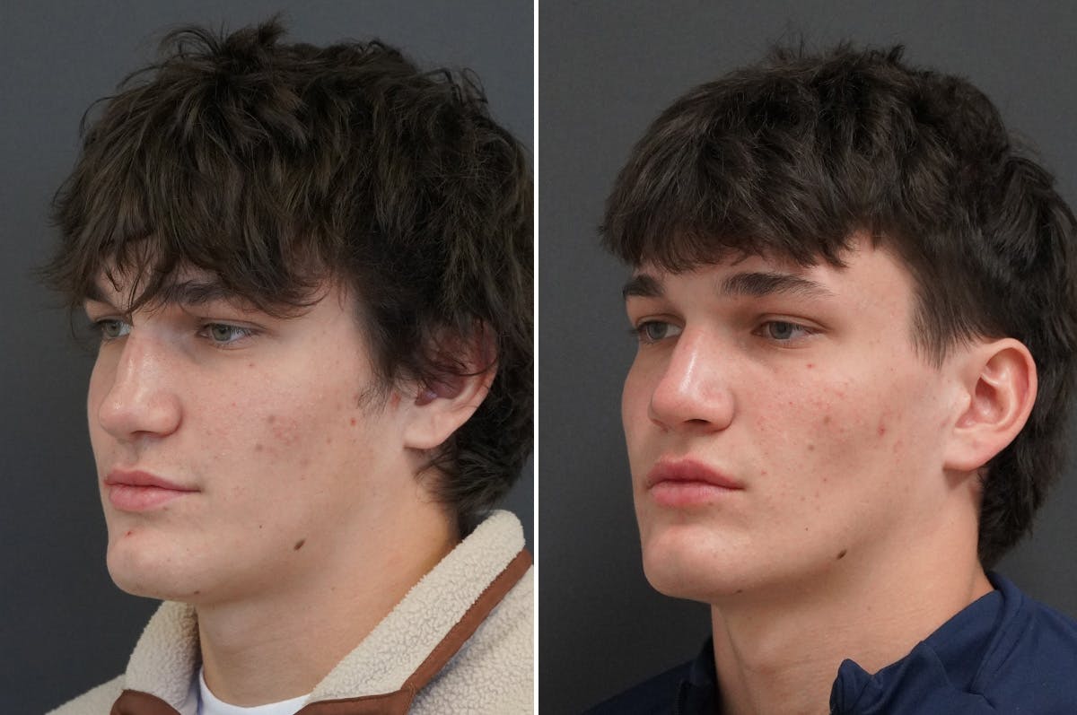 Rhinoplasty Before & After Gallery - Patient 334085 - Image 4