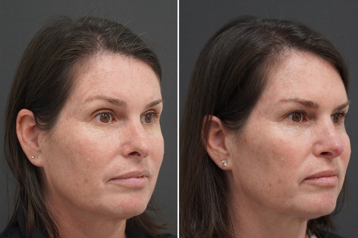 Rhinoplasty Before & After Gallery - Patient 243362 - Image 2