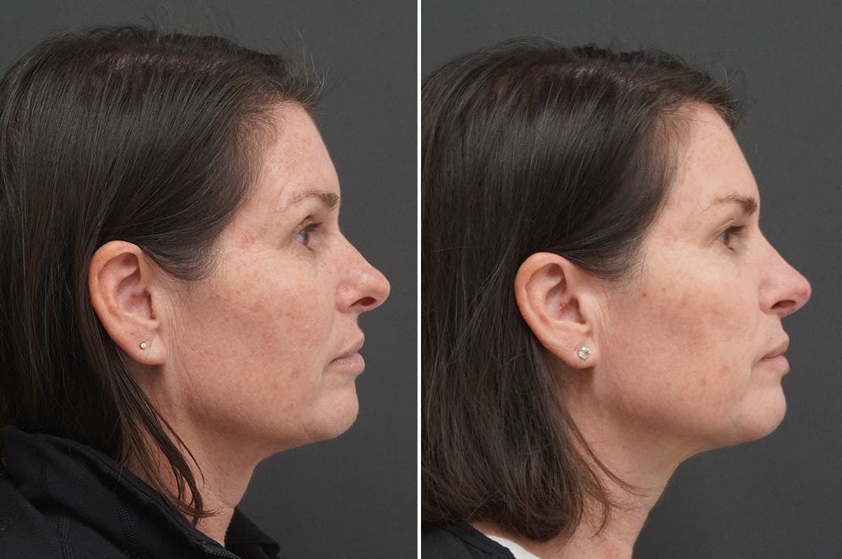 Rhinoplasty Before & After Gallery - Patient 243362 - Image 1