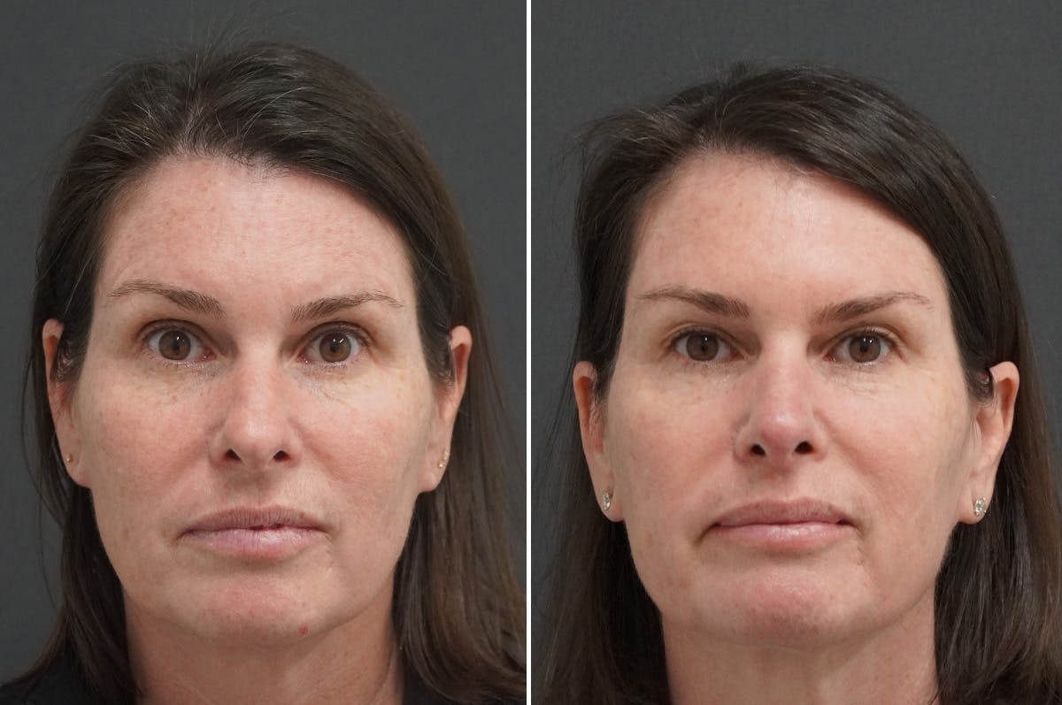 Rhinoplasty Before & After Gallery - Patient 243362 - Image 3